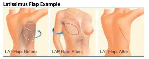 Figure of a latissimus flap reconstruction