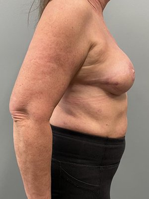 breast reconstruction after side view