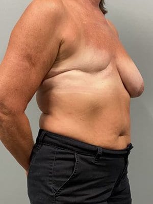 breast reconstruction before angle view