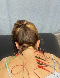 patient receiving dry needling treatment