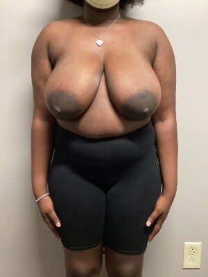 Breast Reduction Before