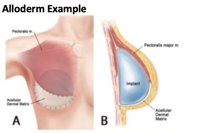 Figure of an Alloderm sling in breast reconstruction