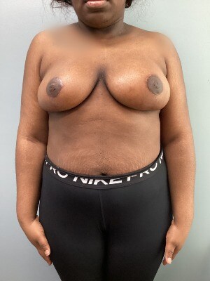 Breast Reduction After