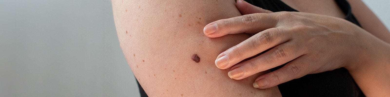 white woman's arm and hand gesturing toward a large mole on the upper arm